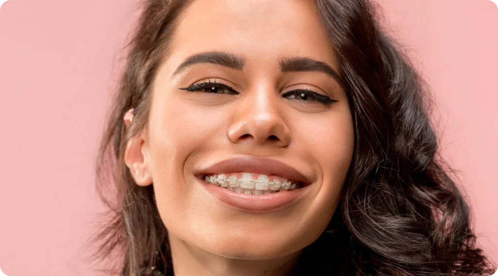 orthodontiste Fécamp multi-attaches en céramique
