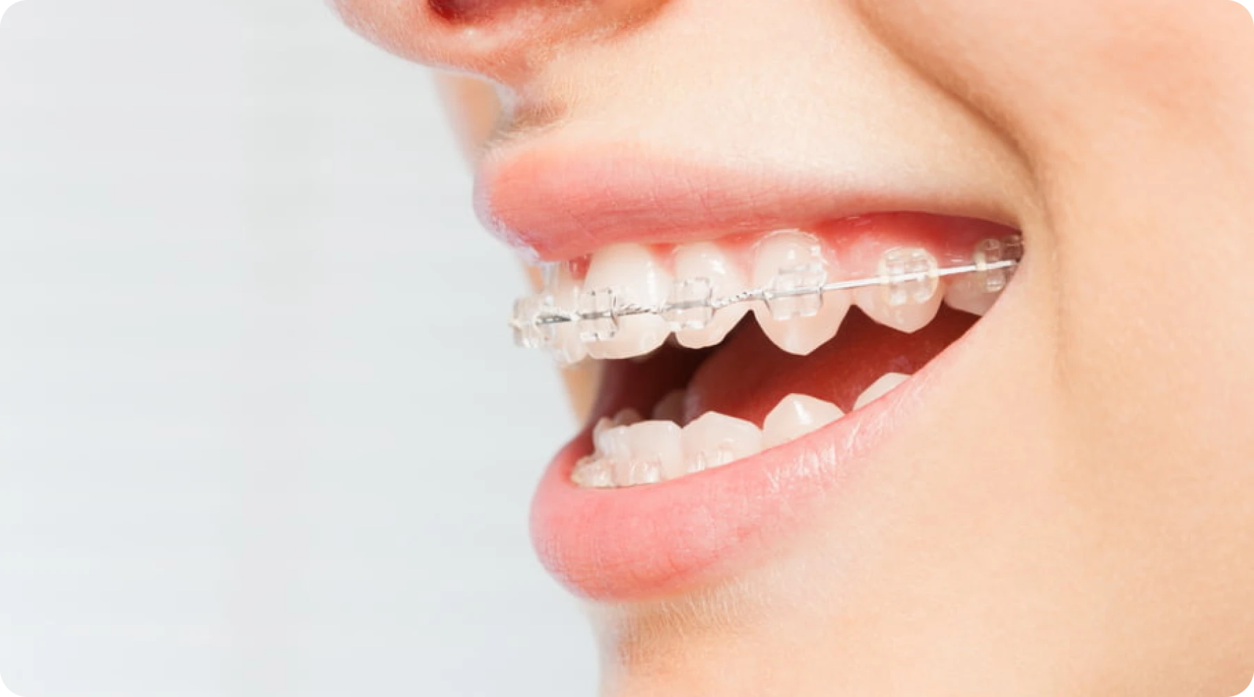 multi-bagues-ceramique orthodontie-fecamp