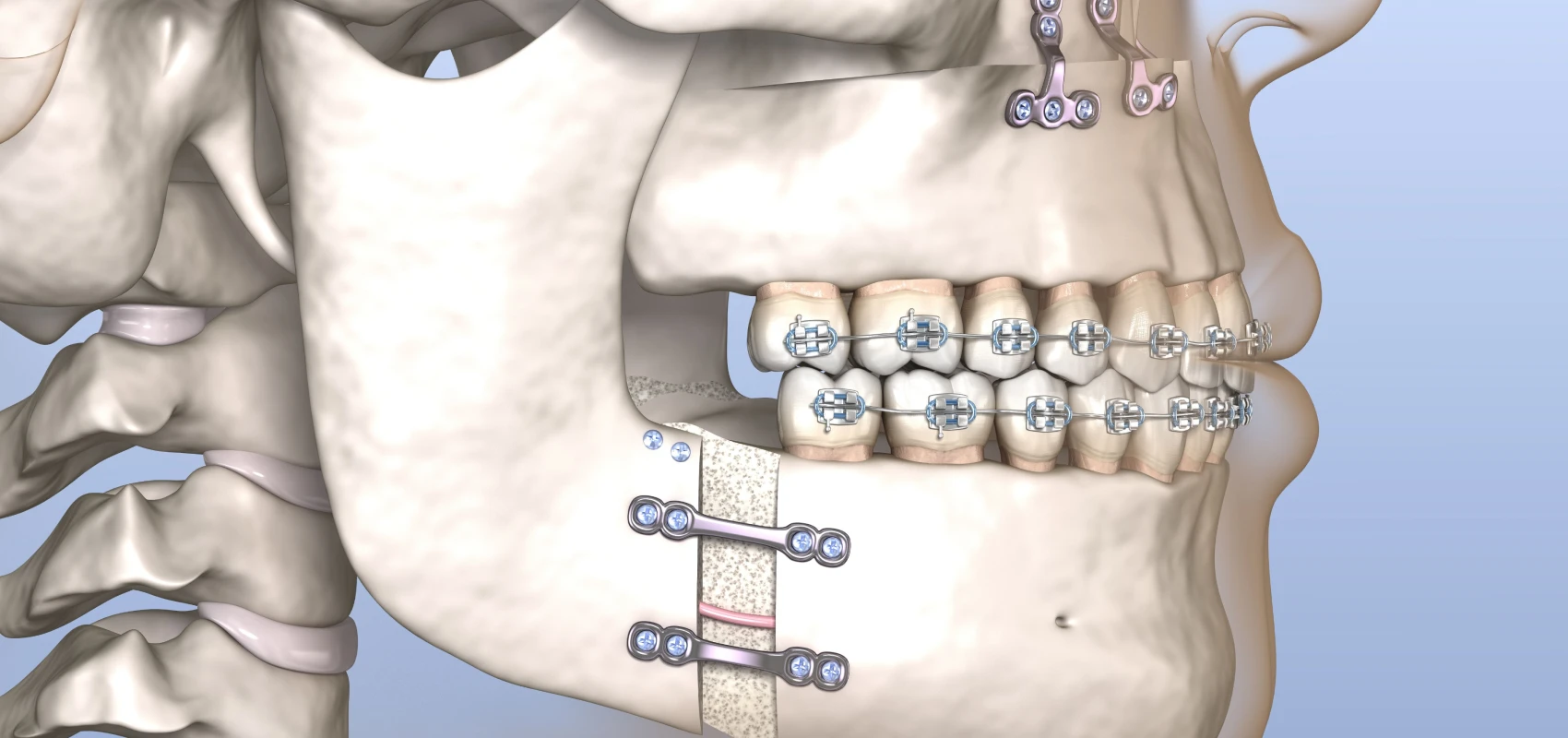 Chirurgie orthognatique | Dr Camille Capela à Fécamp